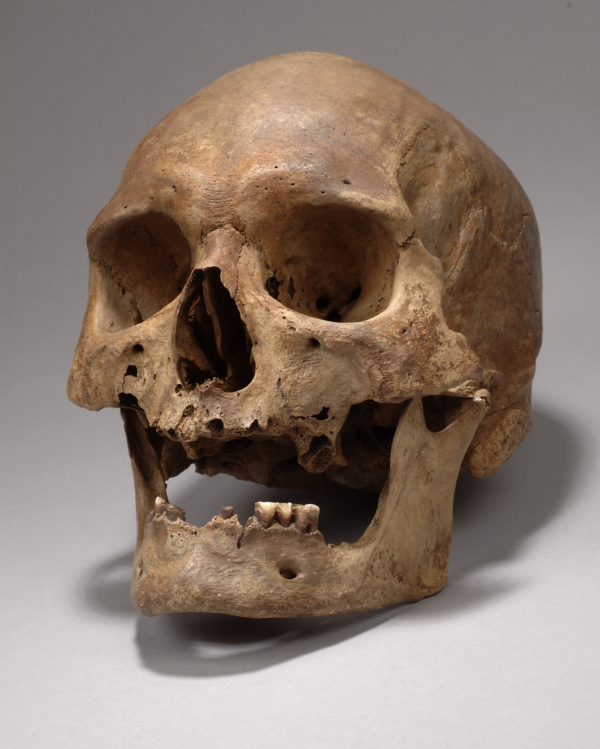 Bredgårdsmannens kranie